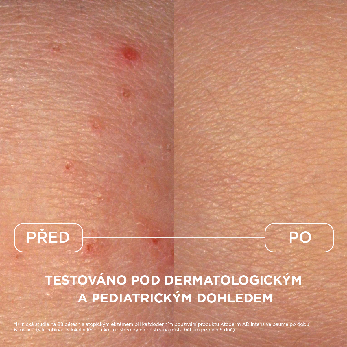 Bioderma Atoderm Intensive Baume zklidňující balzám proti svědění pro atopickou pokožku 45 ml