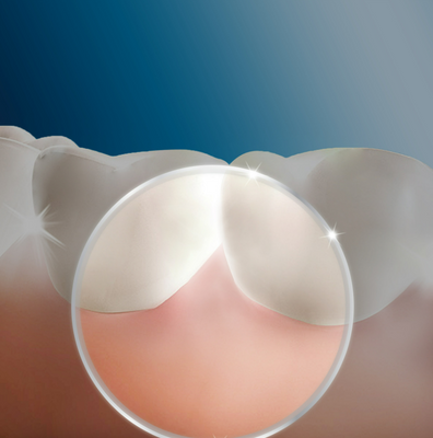 Oral-B ED 17-4 Oxyjet Náhradní tryskové nástavec 4 ks