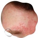 seborea, seboroická dermatitida