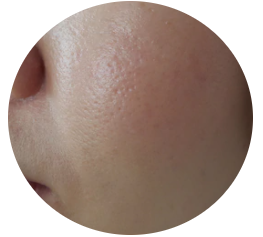 čištění mastné pleti