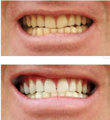 Oralgen NuPearl 32x sada na bělení zubů s bělícím perem zdarma,