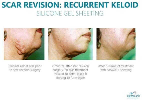 New Gel+ Béžová silikonová náplast (1ks)